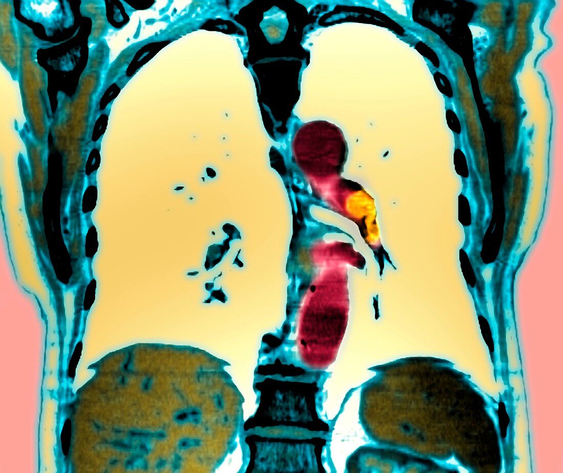 Pulmonary embolism,CT scan