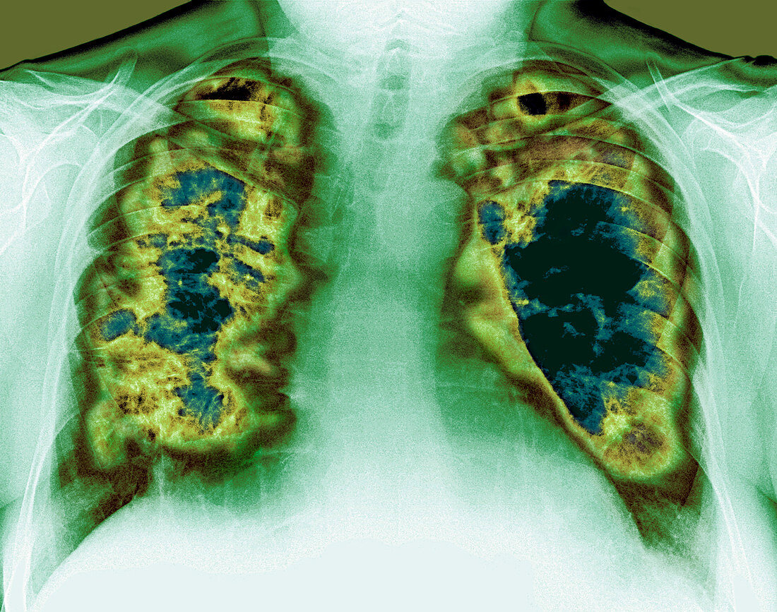 Loss of lung tissue,X-ray