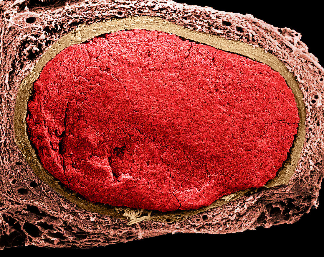 Blood vessel clot,SEM