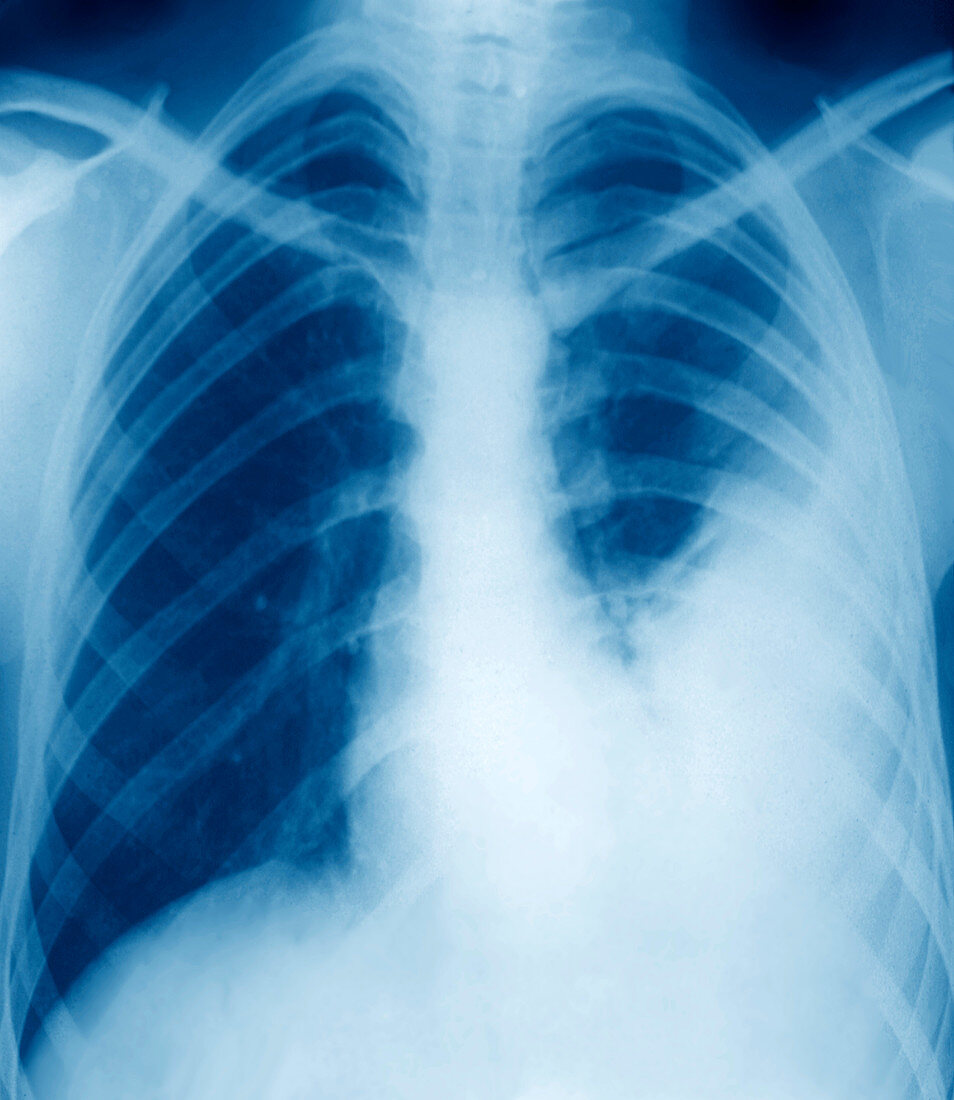 Pulmonary embolism,X-ray