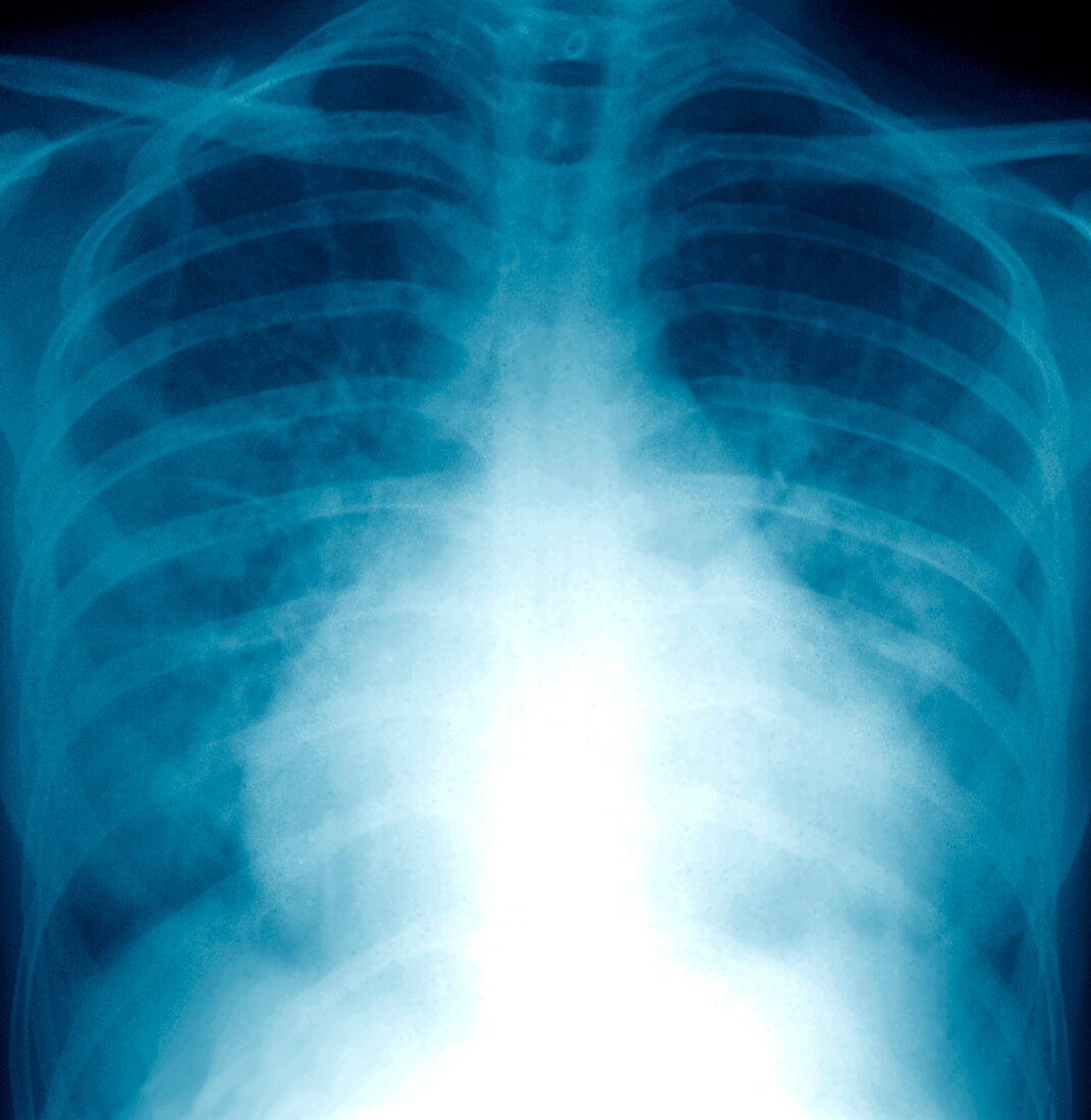 Pulmonary embolism,X-ray