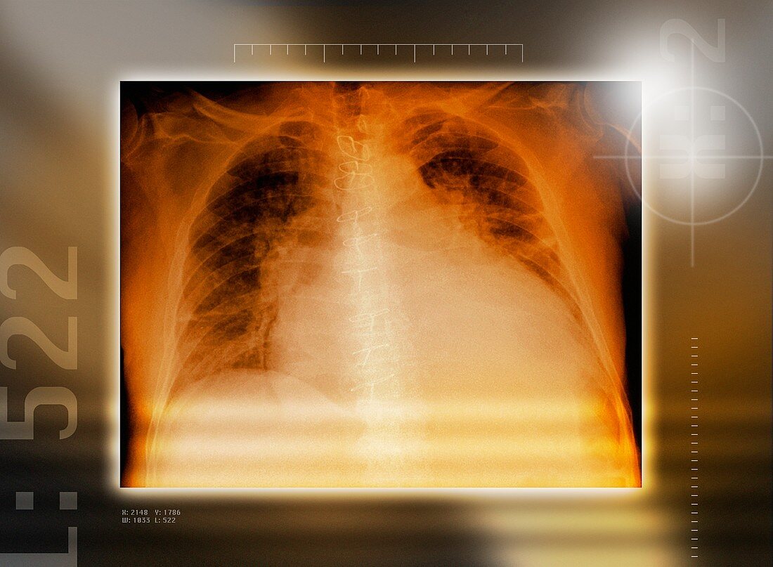 Heart failure,chest X-ray