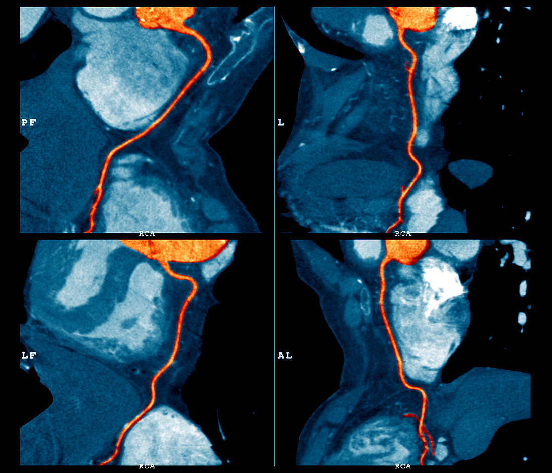 Coronary stent,CT scan