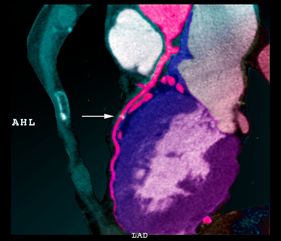 Coronary stent,CT scan