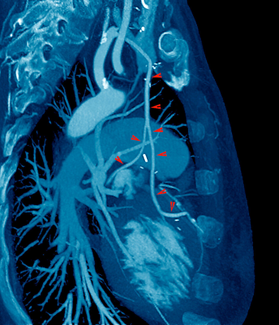 Heart bypass grafts,CT scan