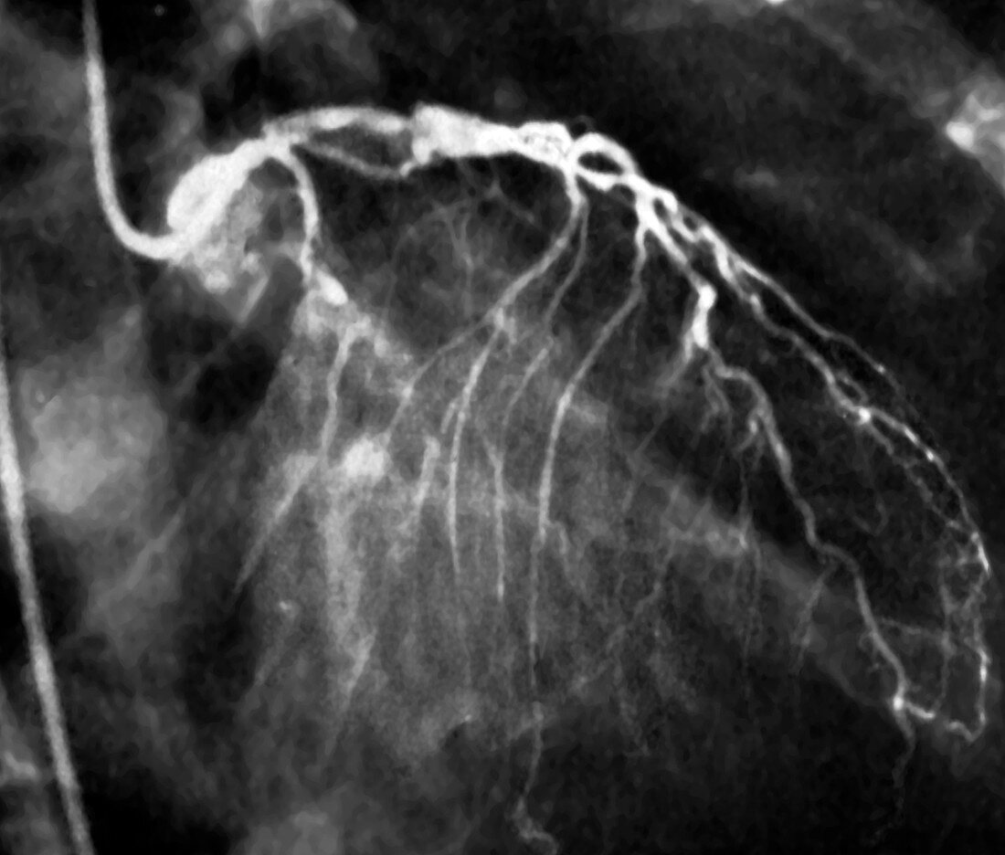 Narrowed coronary arteries,X-ray