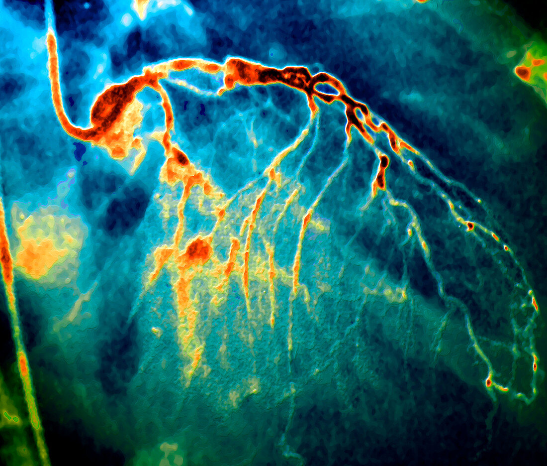 Narrowed coronary arteries,X-ray