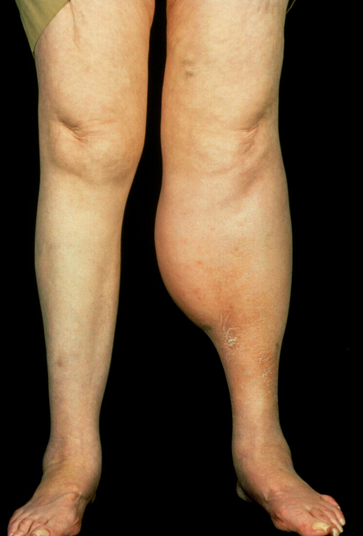 Woman with swollen left calf due to DVT