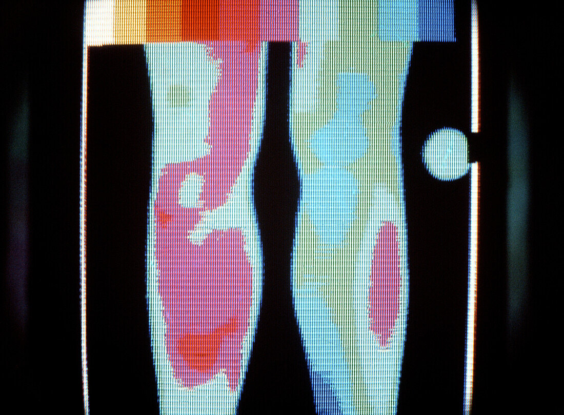 Thermogram of legs showing deep vein thrombosis