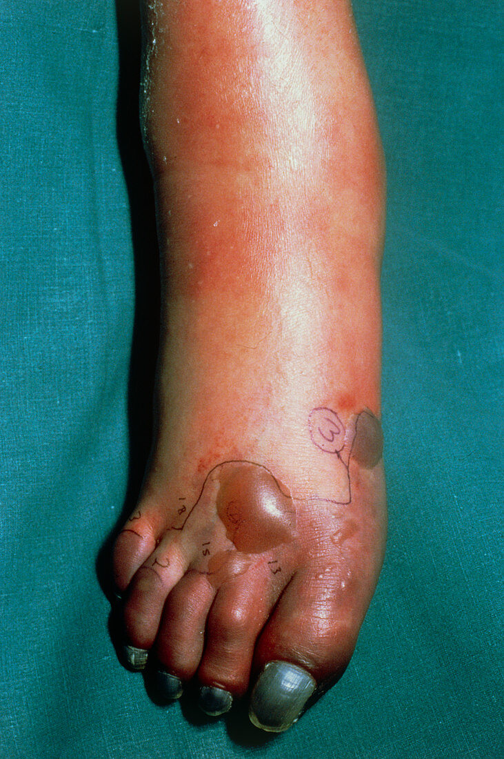 Gangrenous foot due to deep vein thrombosis