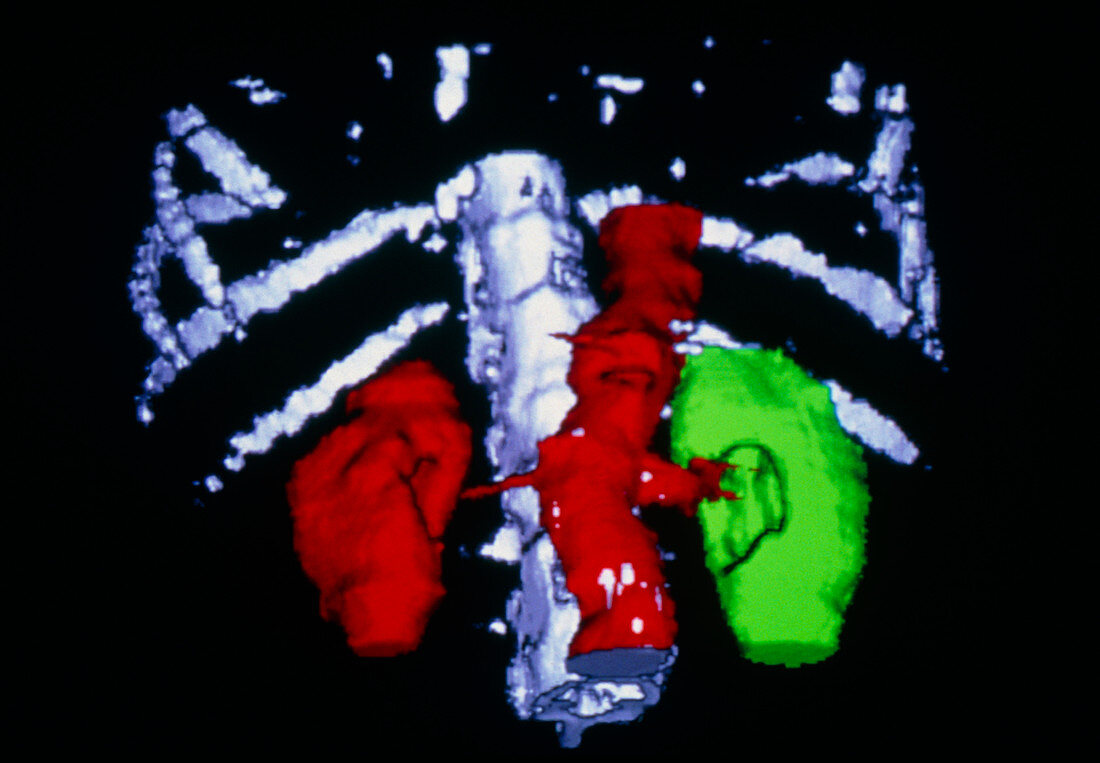 False-colour 3-D CT scan: renal artery stenosis
