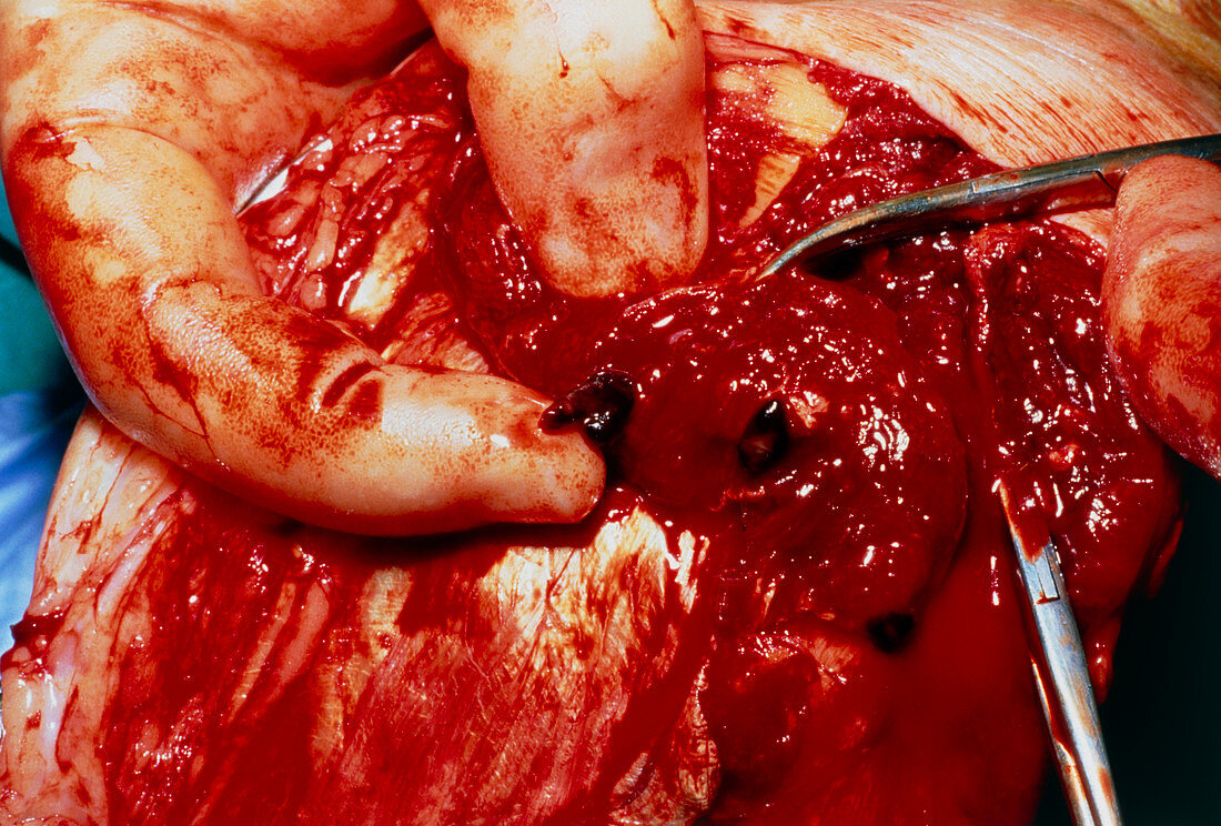 Close-up showing thrombi in deep vein thrombosis