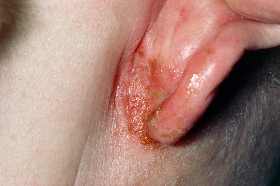 Impetigo lesion on a patient's ear lobe