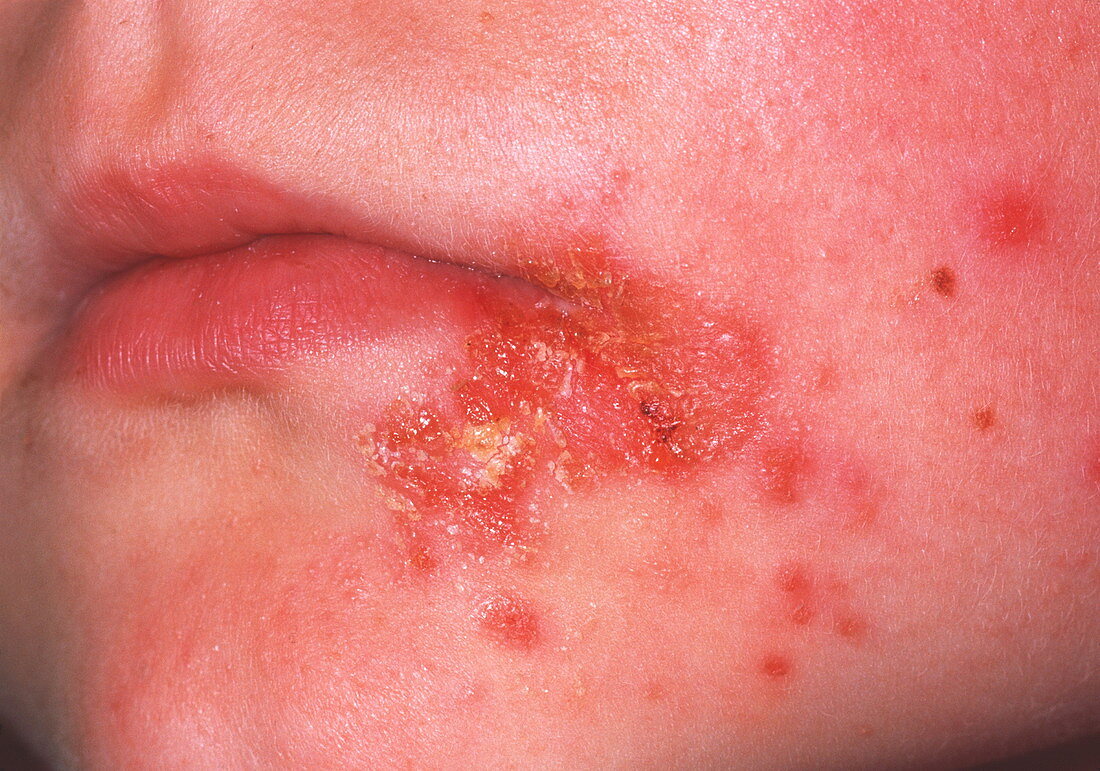 Impetigo skin infection