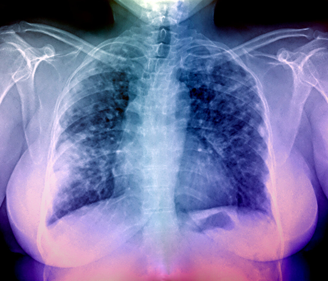 Lung disease,X-ray