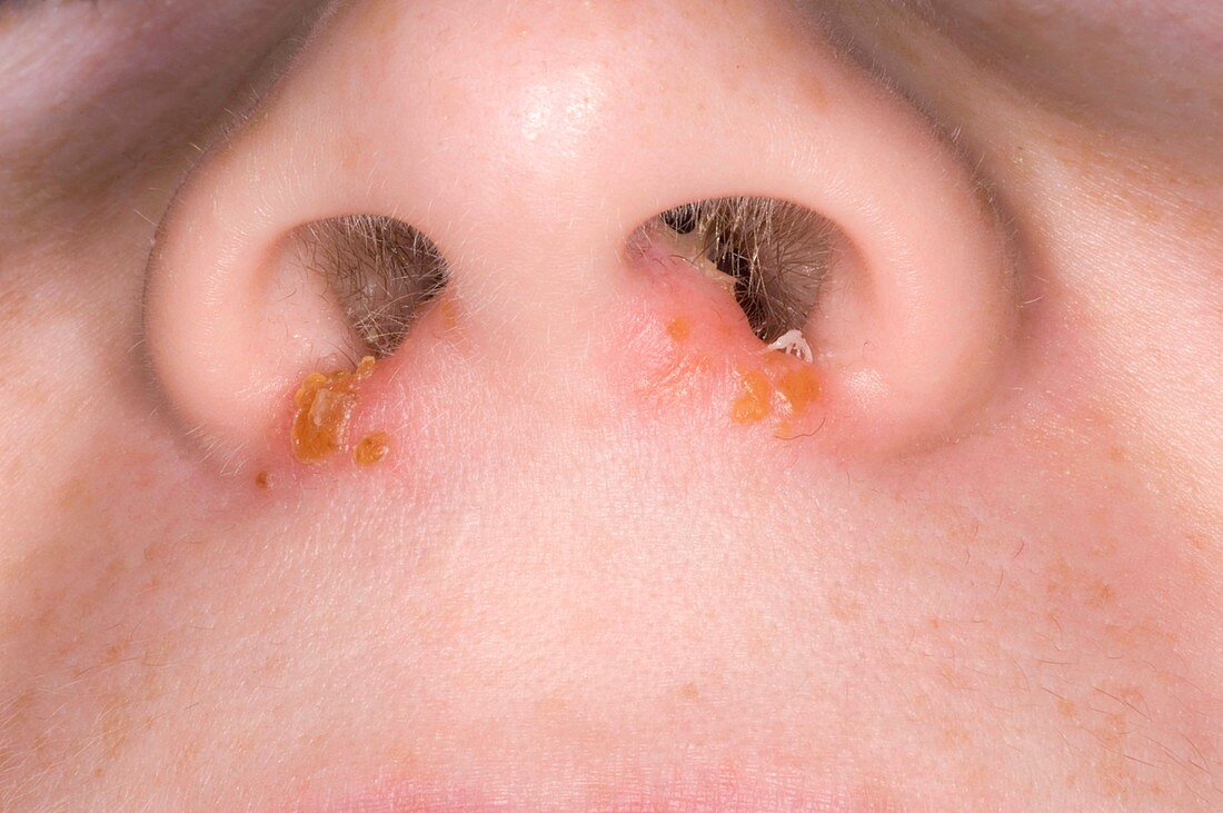 Impetigo infection on nose