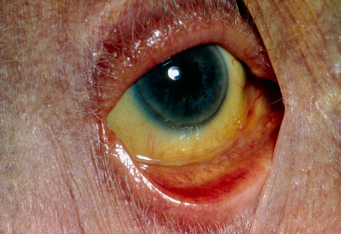 Close-up of yellow eyeball in jaundice