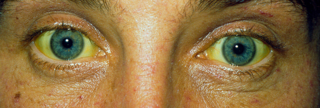 Close up of the eyes of a jaundiced patient