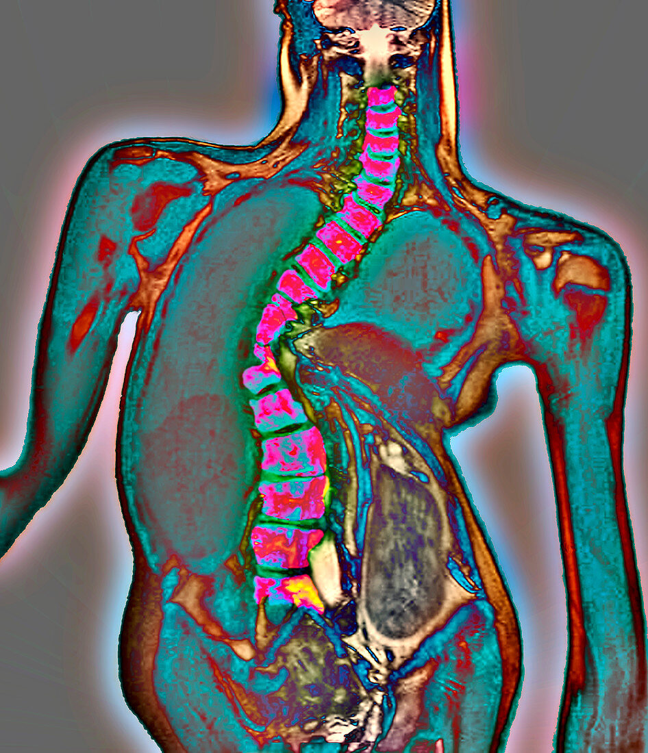 Curvature of the spine,MRI scan