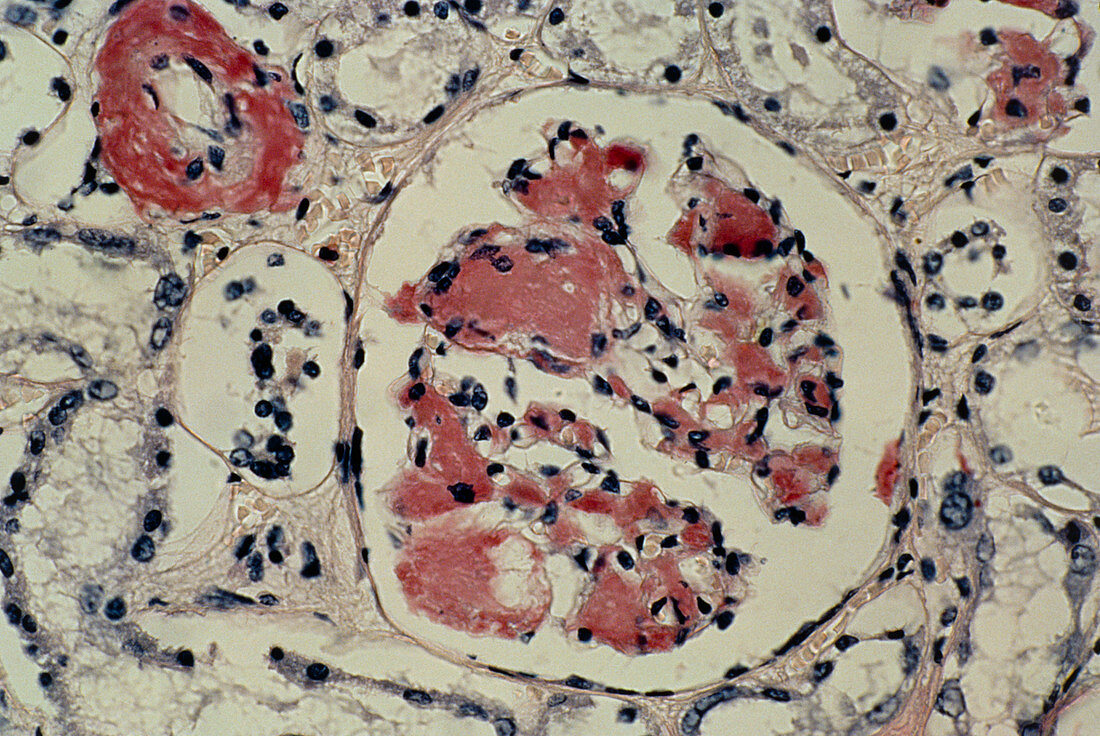 LM of kidney showing amyloid deposits