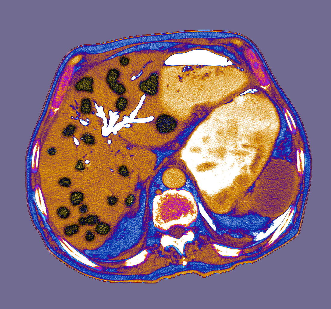 Liver cancer,CT scan