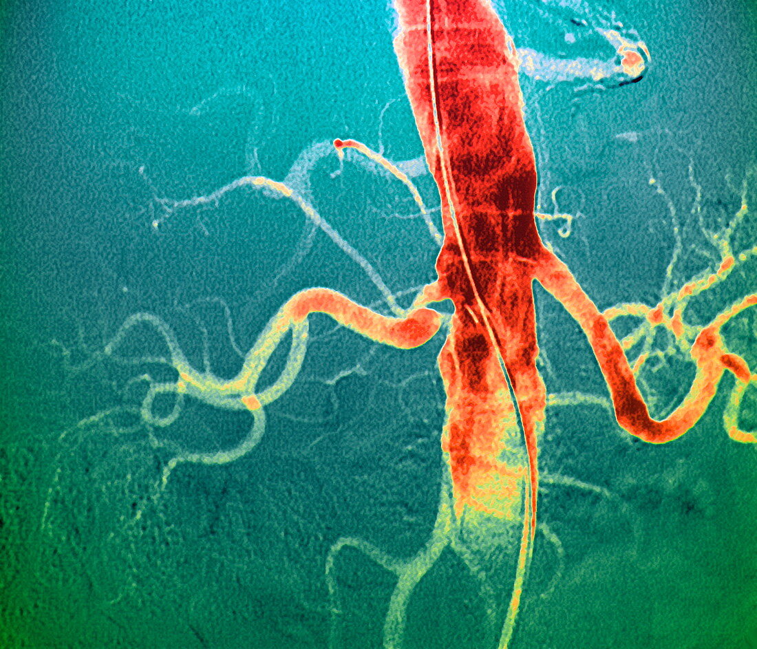 Narrowed renal artery,X-ray