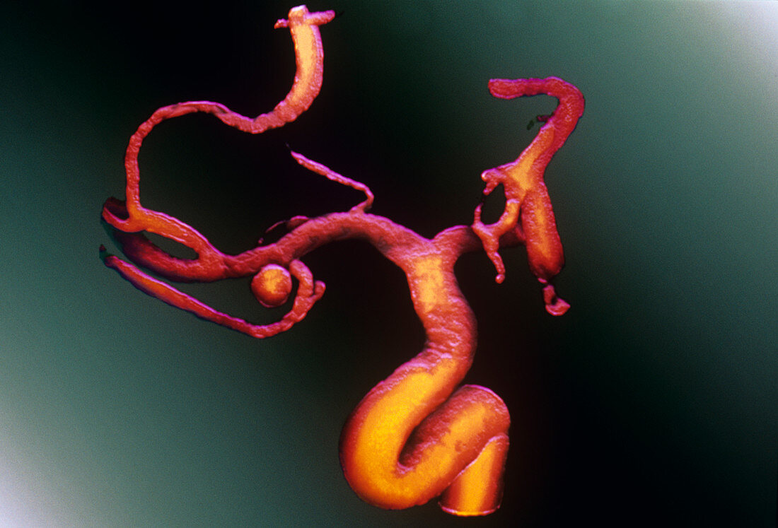 Carotid aneurysm,digital angiogram