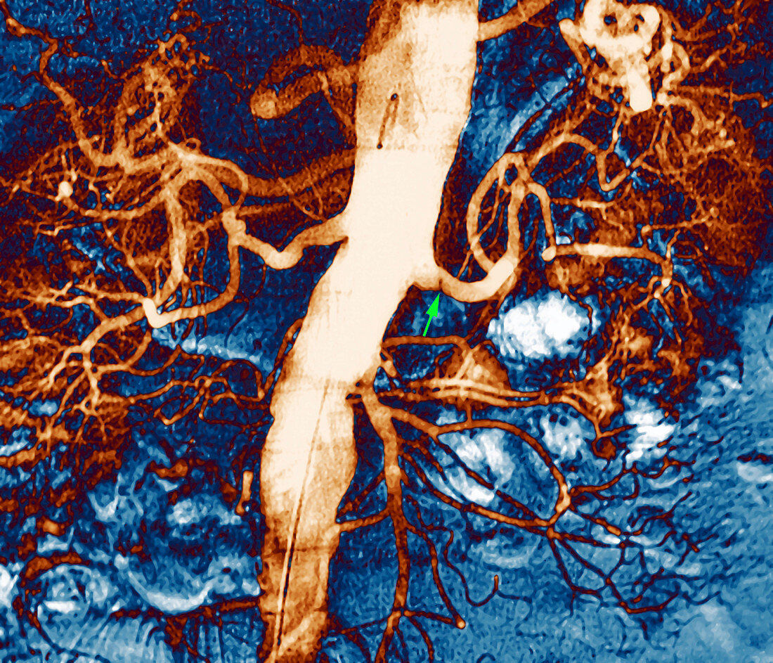 Narrowed renal artery,X-ray