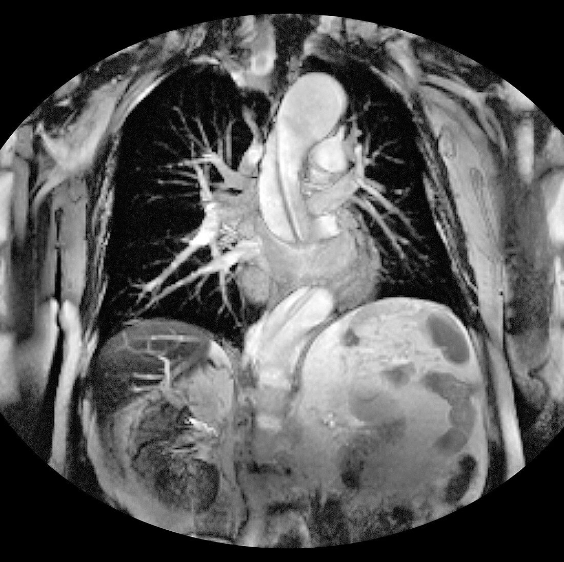Dissecting aorta,MRI scan