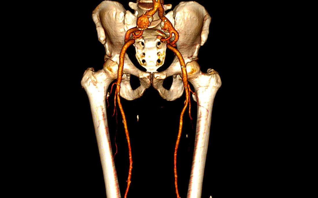 Iliac aneurysm,CT scan