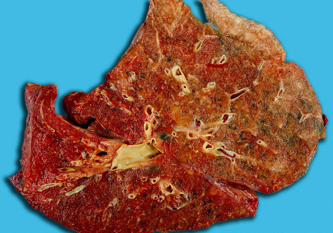 Atheroma of vessels of the lung
