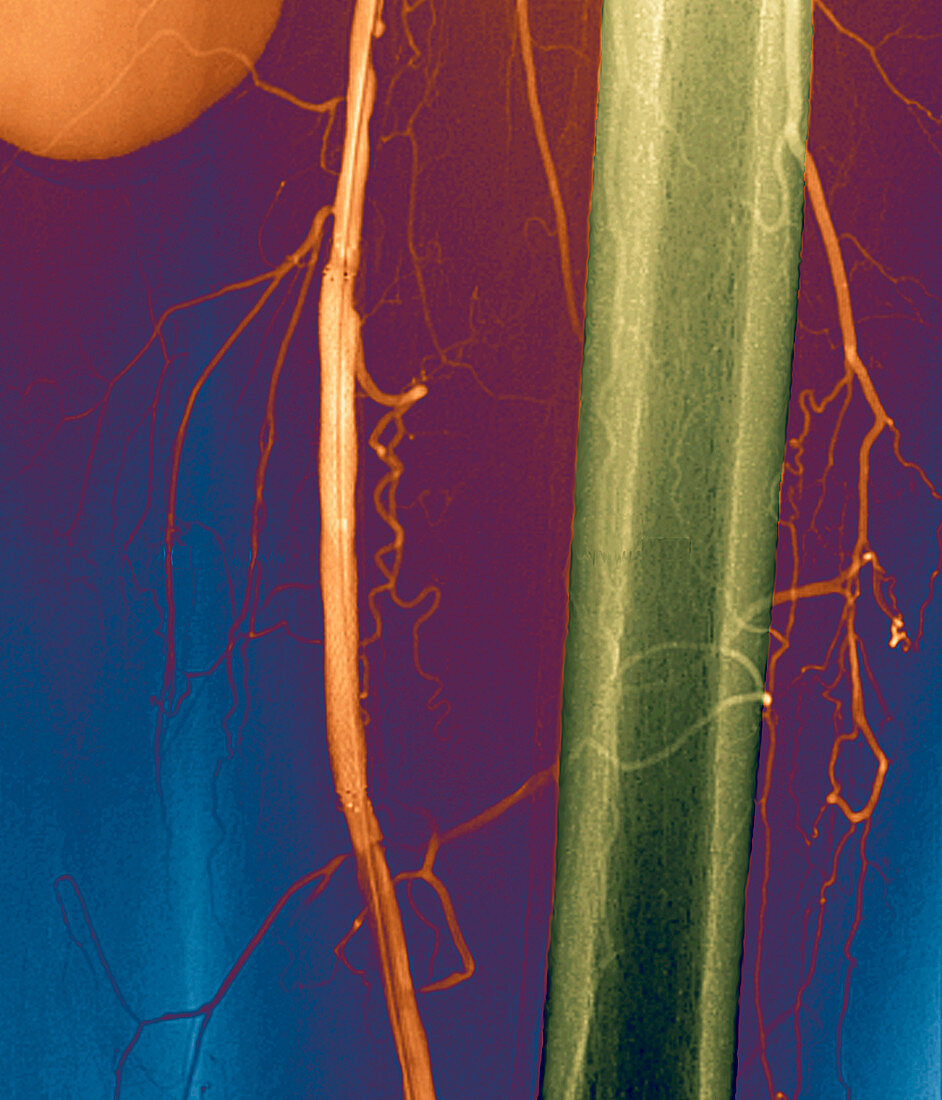 Stent in a femoral artery,angiogram