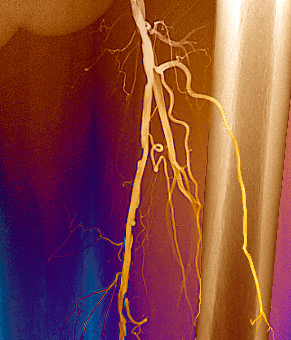 Narrowed femoral artery,angiogram