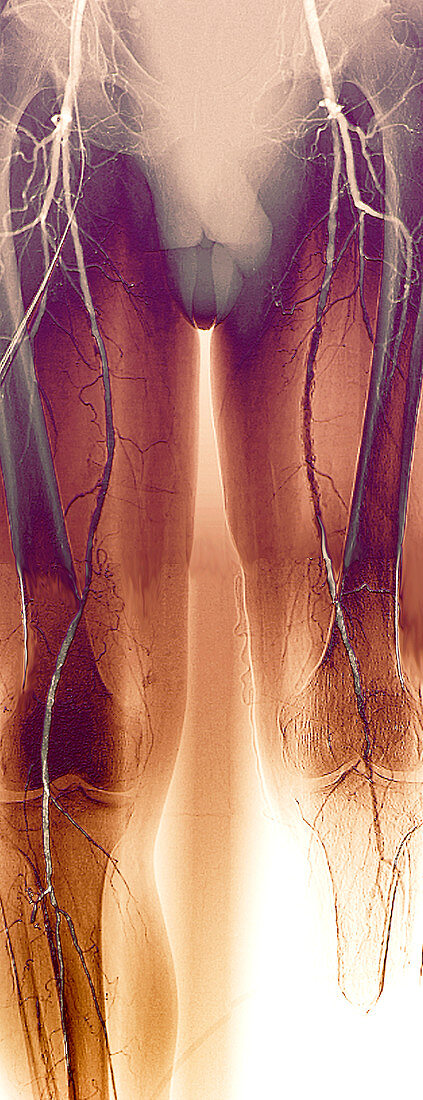 Narrowed leg arteries,angiogram