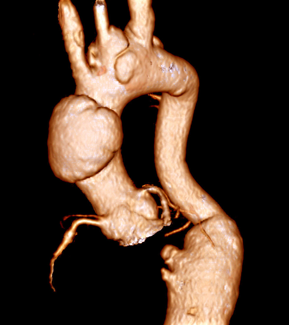 Aortic aneurysms,3D CT scan