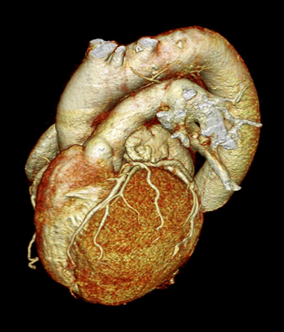 Aortic aneurysm,3D CT scan