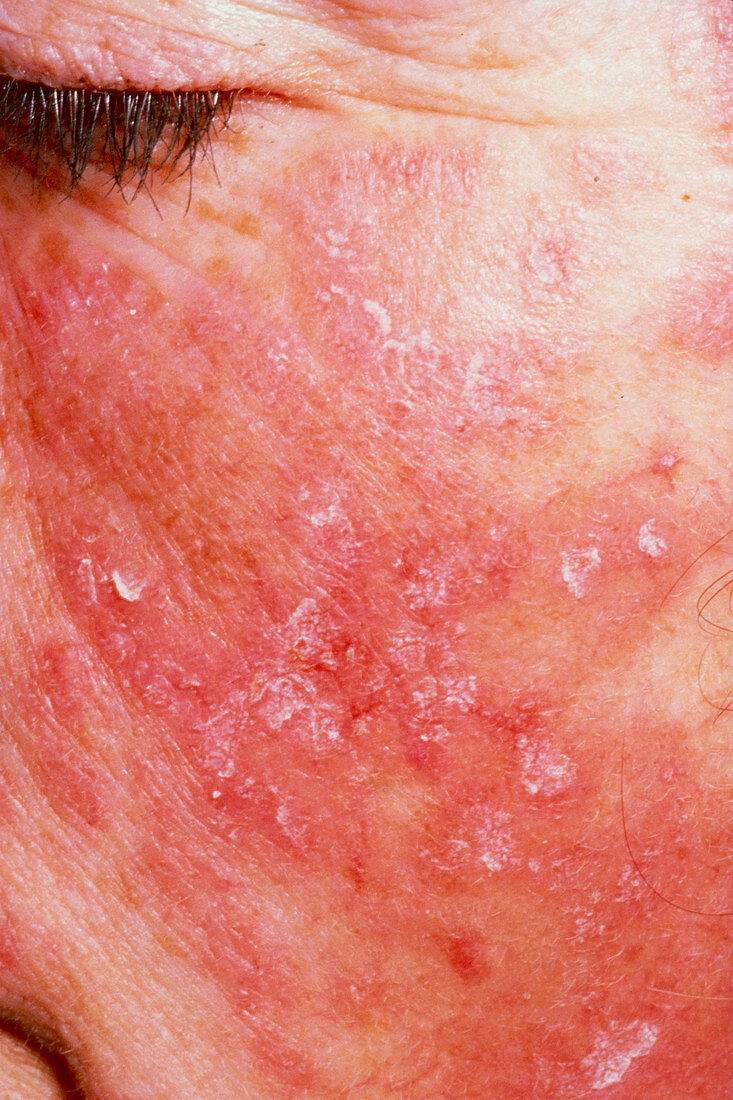 Rash of systemic lupus erythematosus on cheek