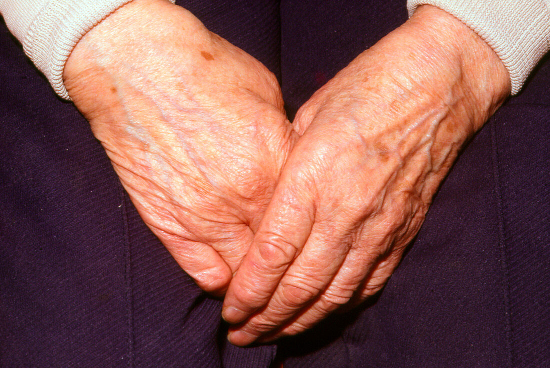 Liver spots on the hands of an elderly woman