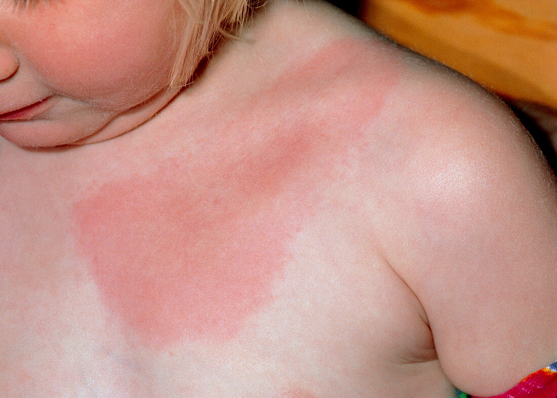 Erythema due to Lyme disease on young girl's chest