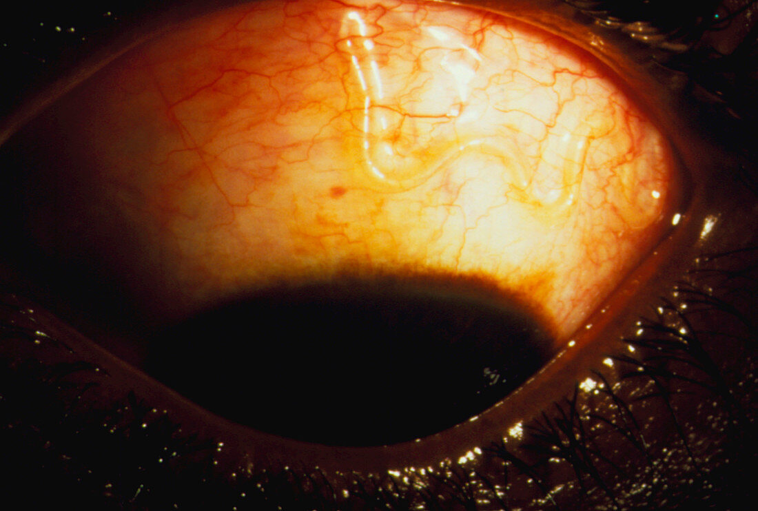 Eye closeup with Loa loa worm parasite