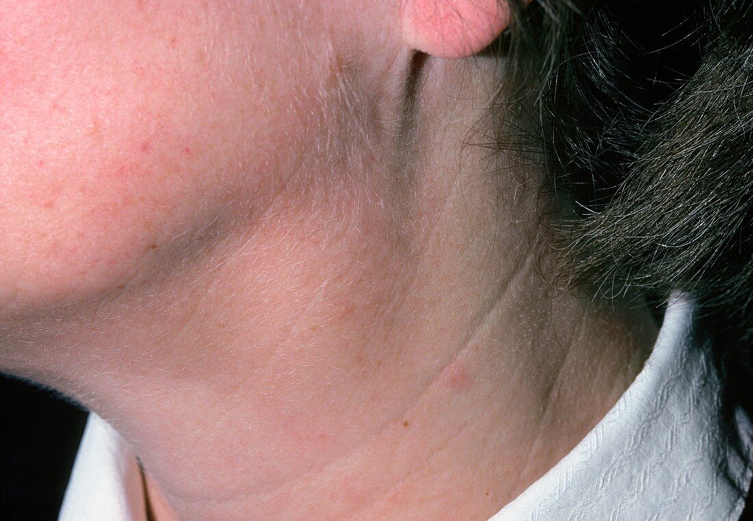 Swollen glands (lymphadenopathy) in woman's neck