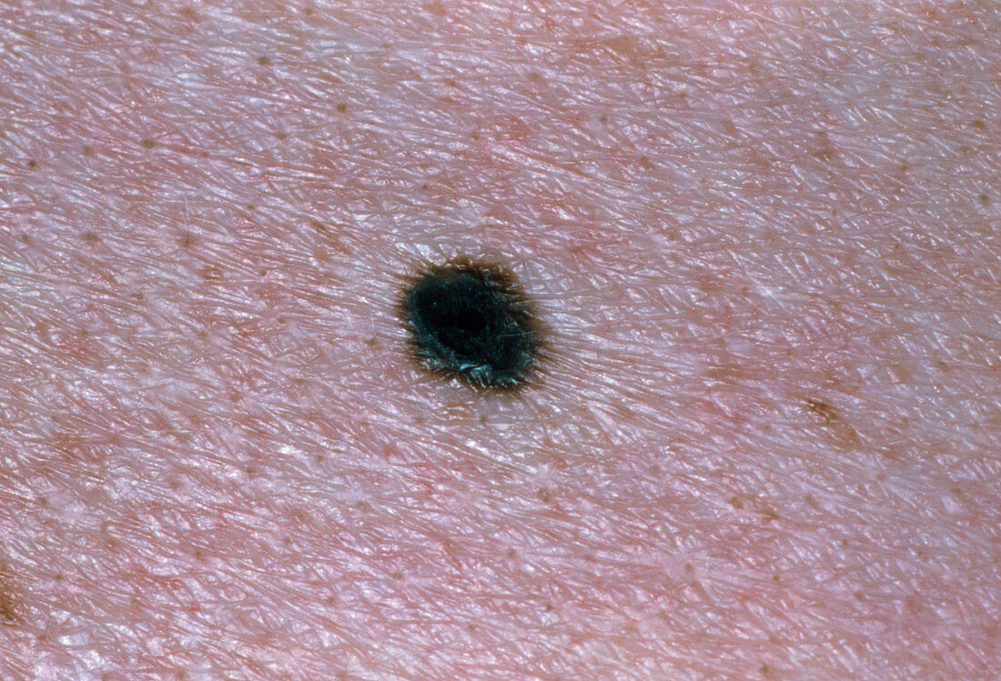 Close-up of skin showing lentigo