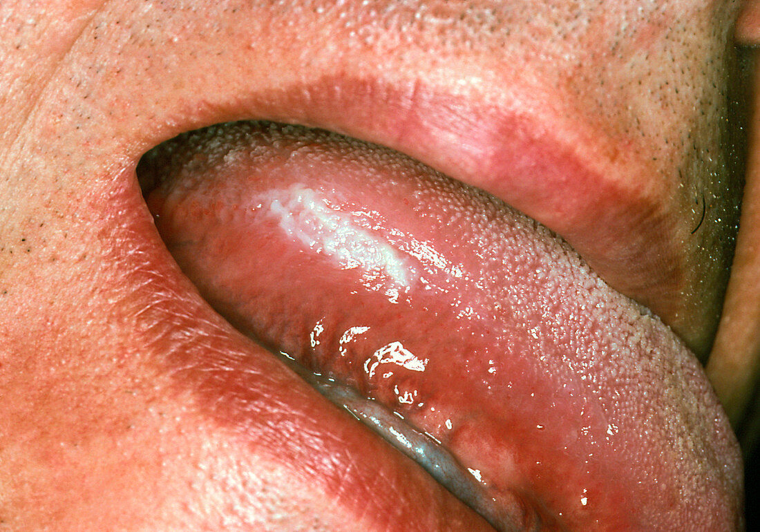 Leukoplakia on side of tongue