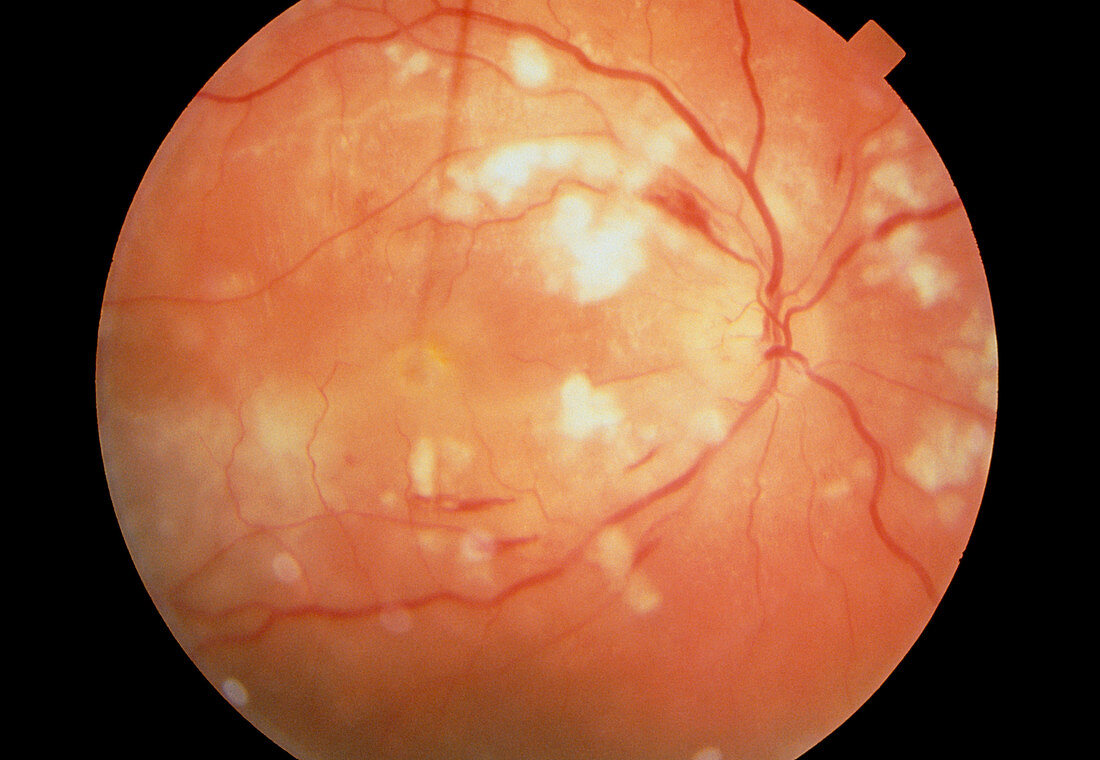 Ophthalmoscopy in systemic lupus erythematosus