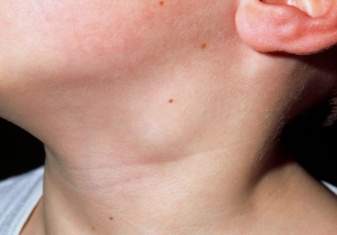 Close-up of swollen lymph node in the neck of boy