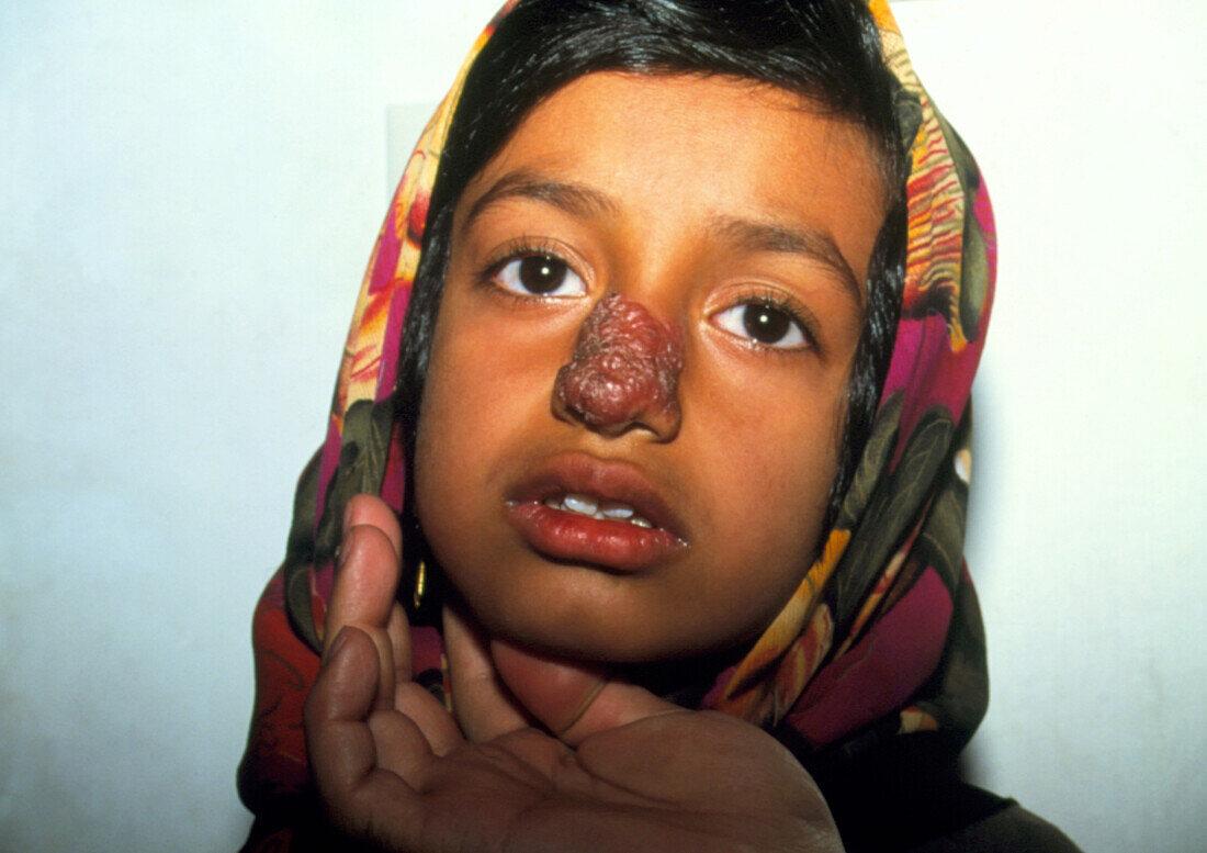Cutaneous leishmaniasis lesion on a girl's face