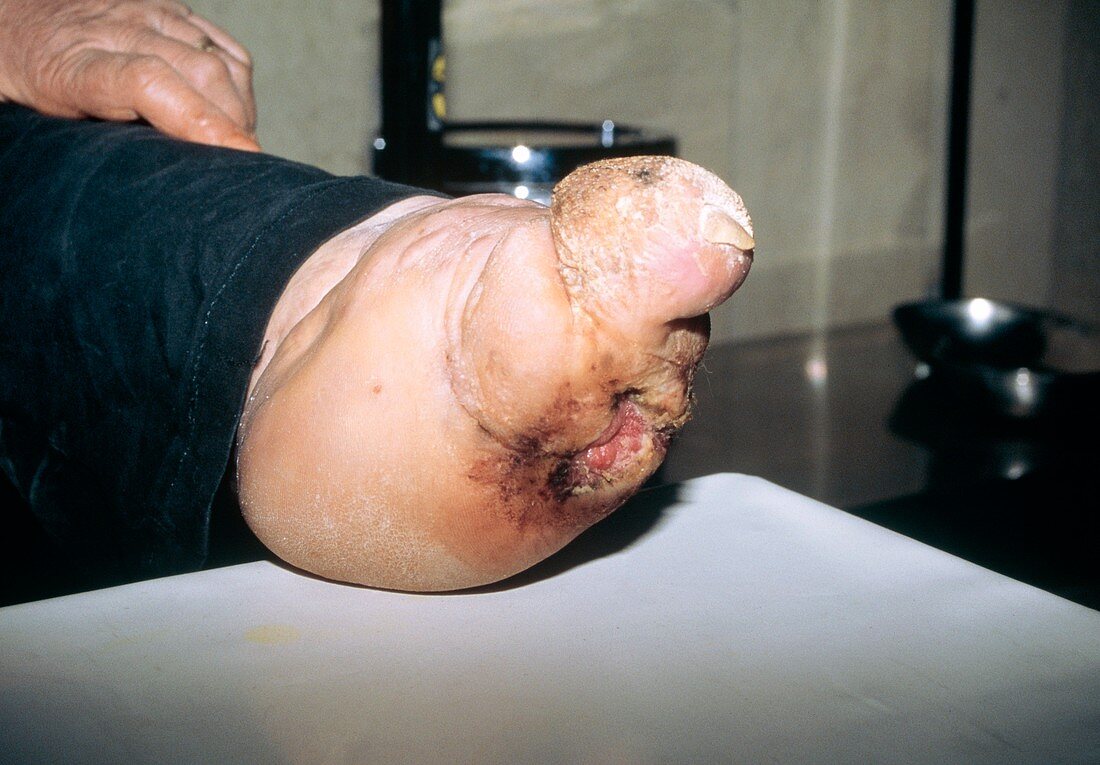 Deformed foot of a person suffering from leprosy