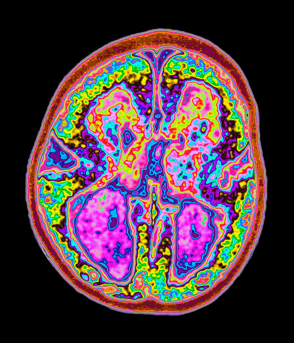 Coloured MRI brain scan showing lissencephaly