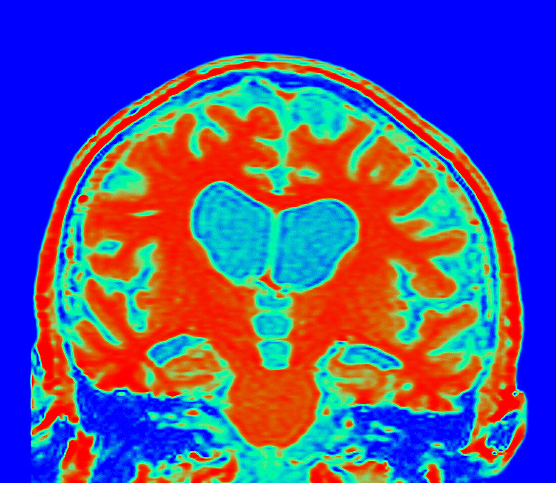 Lewy body disease brain MRI