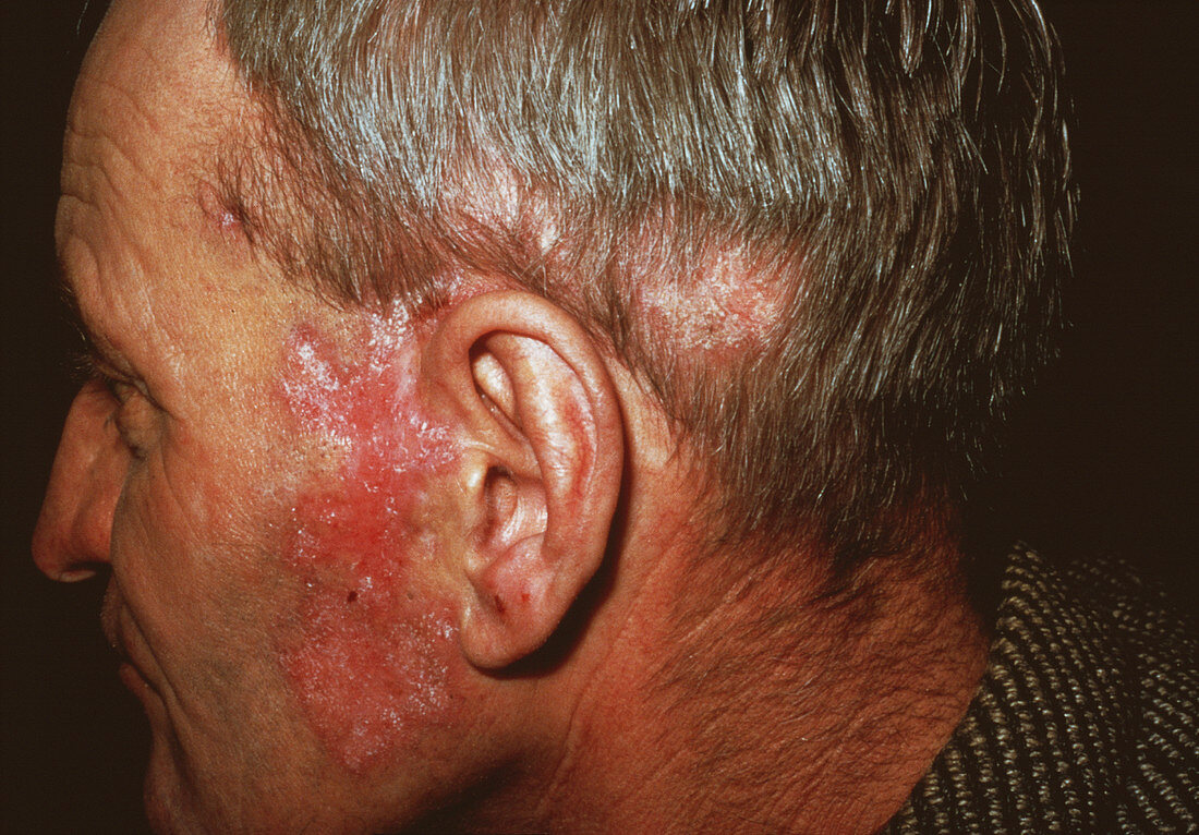 Lupus skin rash
